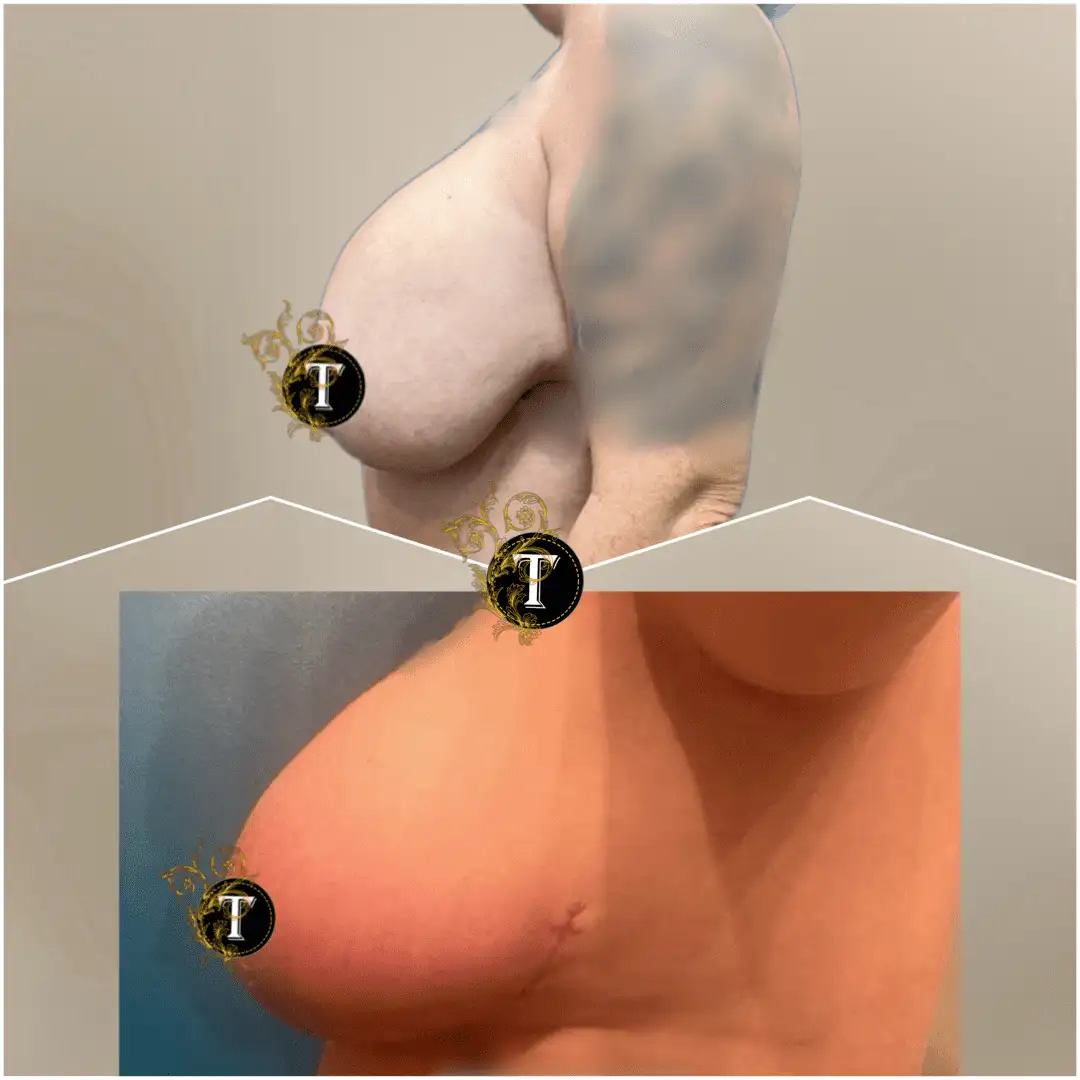 Before and After Image: Breast Lift with Implant - left-side