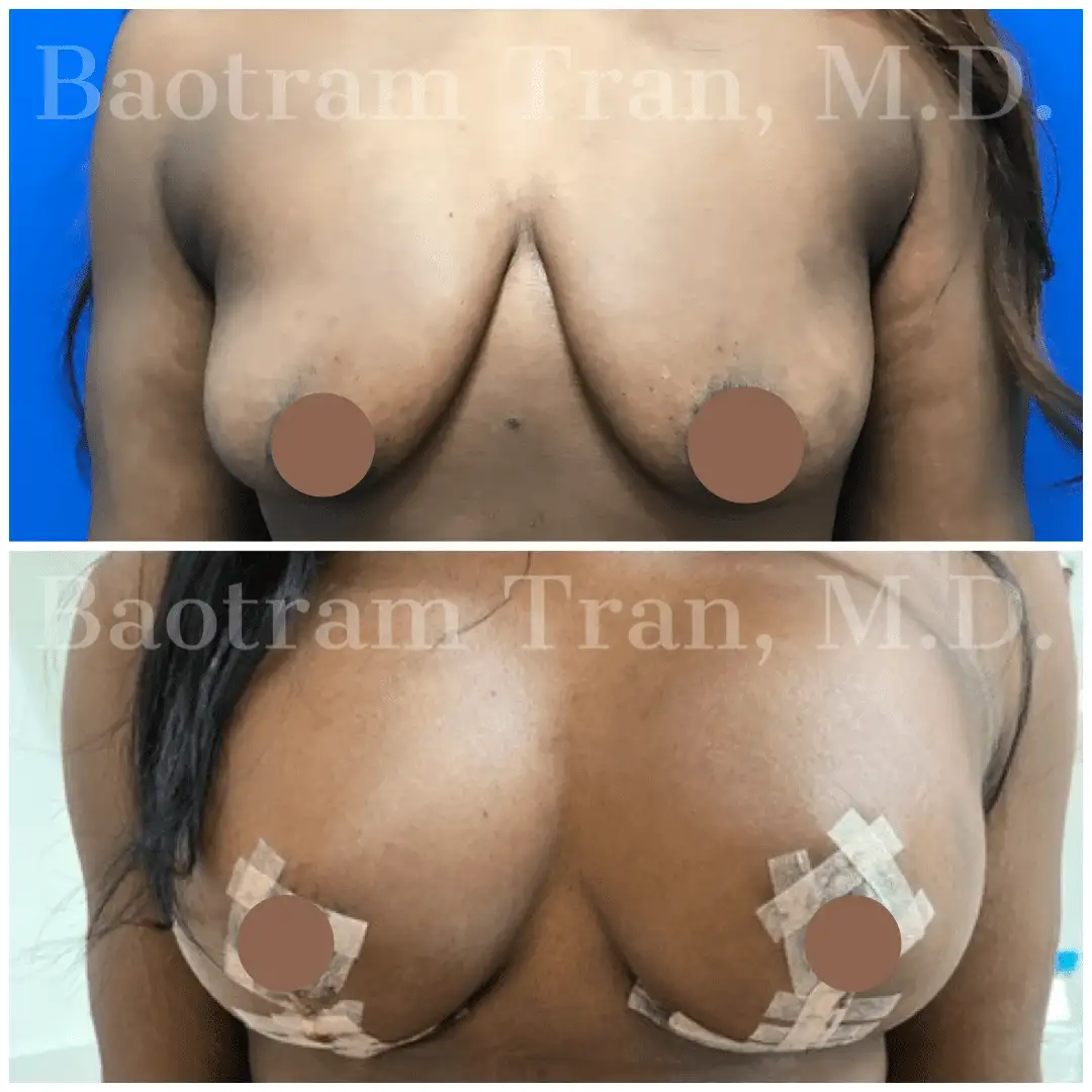 Before and After Image: Breast Lift with Implant - front