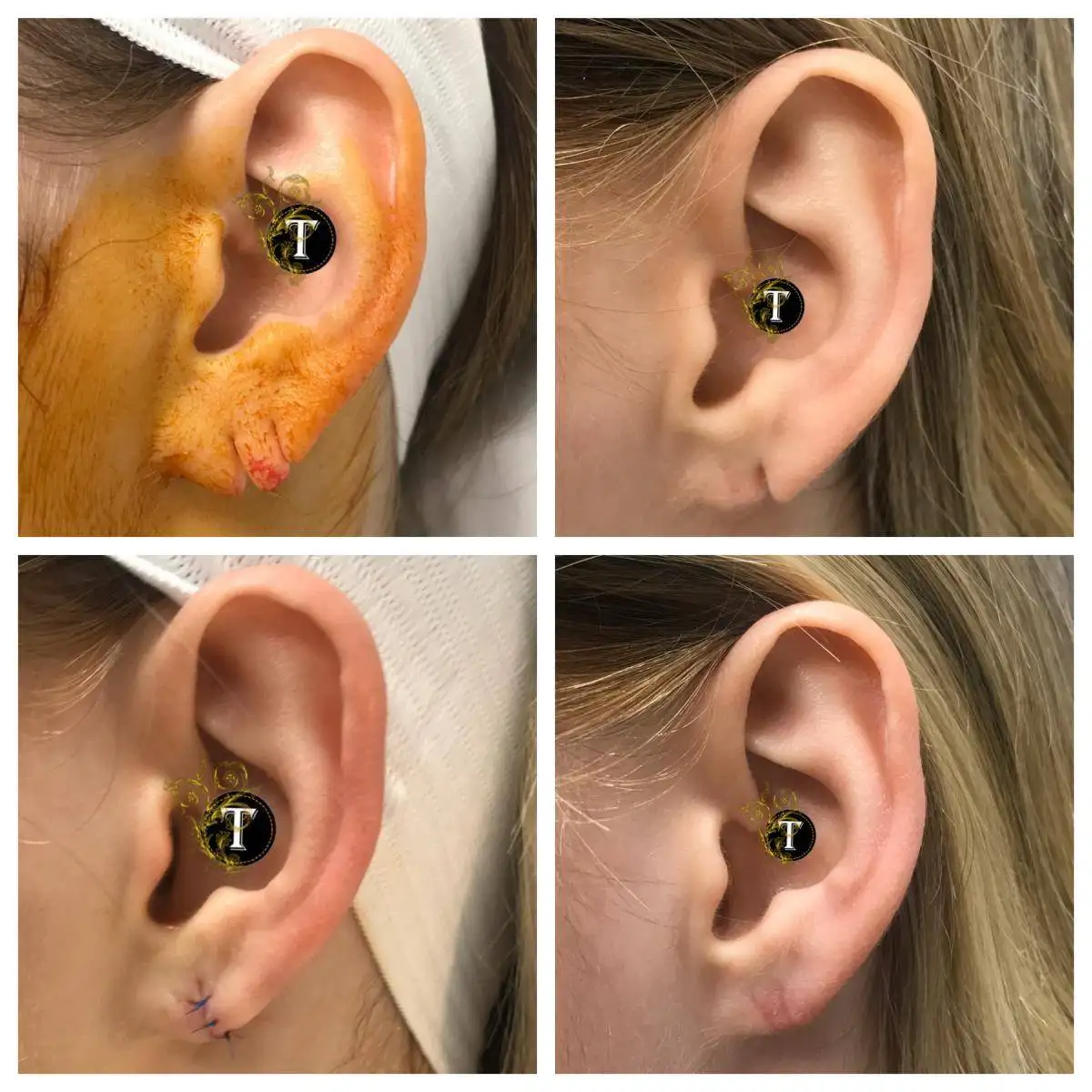 Before and After Image: Earlobe Repair - left-side