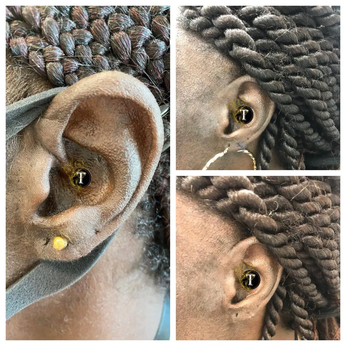 Before and After Image: Earlobe Repair - left-side