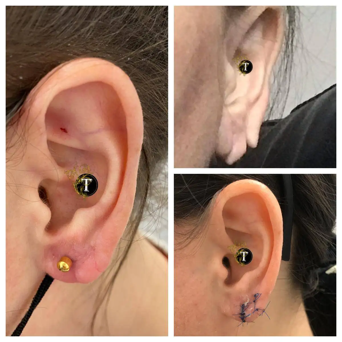 Before and After Image: Earlobe Repair - left-side