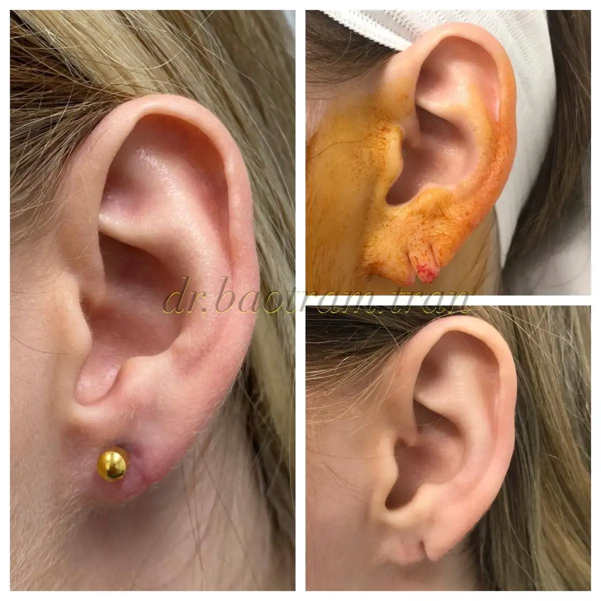 Before and After Image: Earlobe Repair - left-side