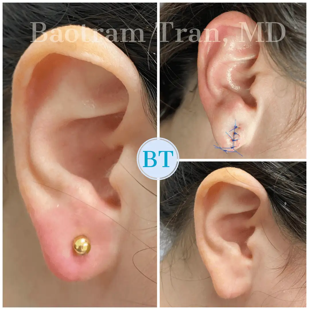 Before and After Image: Earlobe Repair - right-side