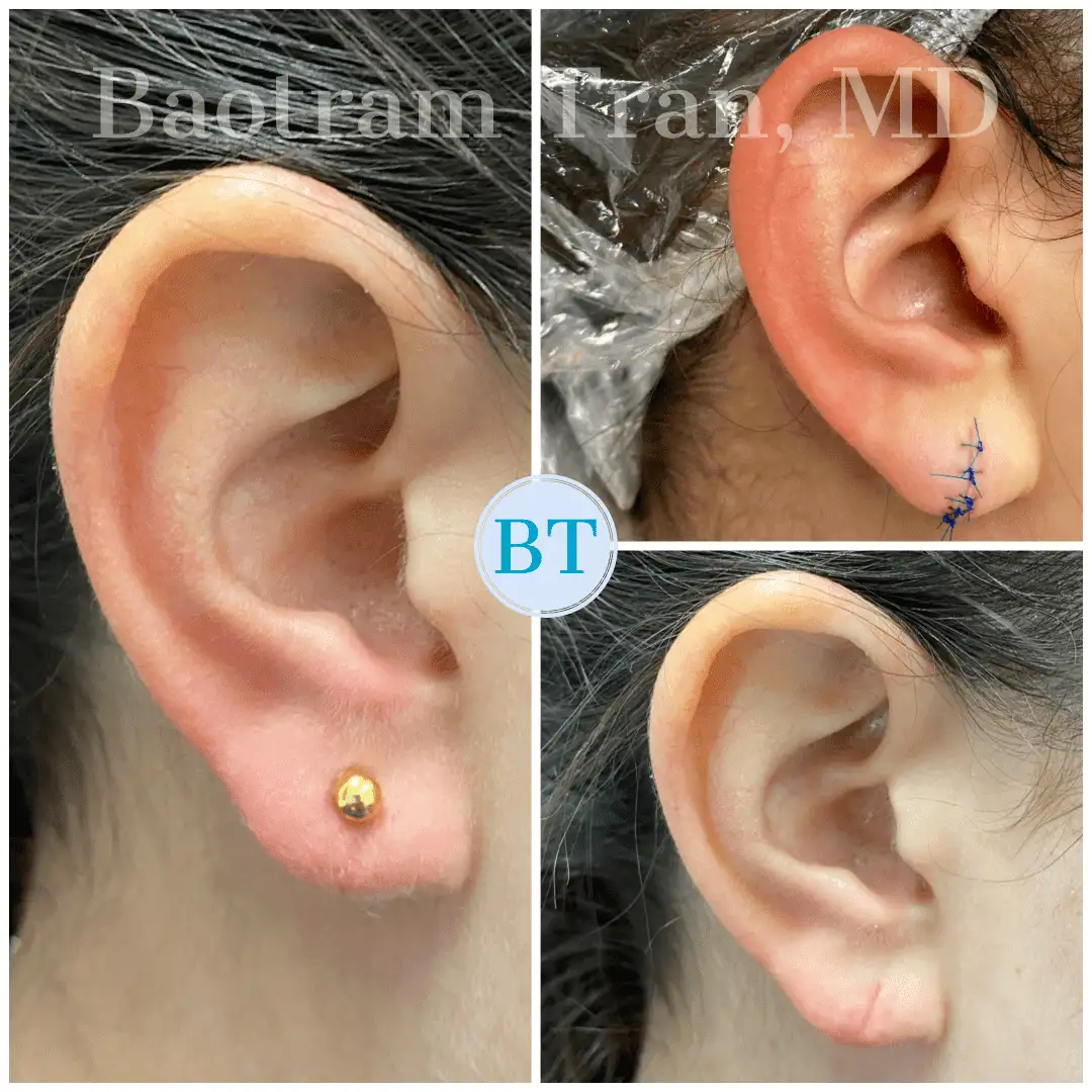 Before and After Image: Earlobe Repair - right-side