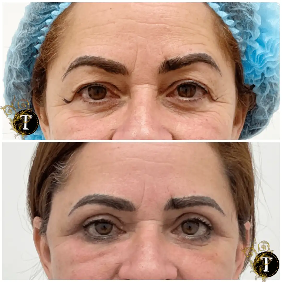 Before and After Image: Eyelid Surgery - front