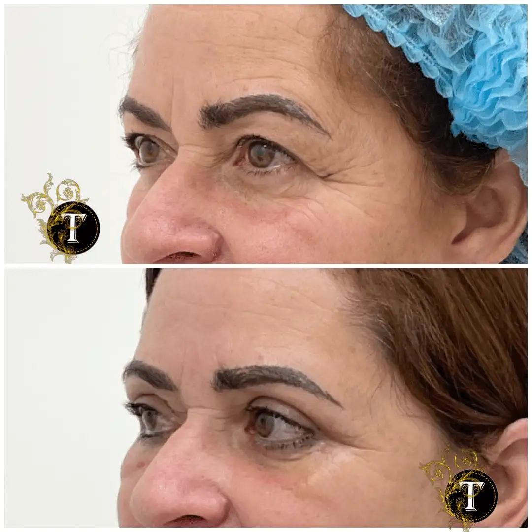 Before and After Image: Eyelid Surgery - left-front-oblique