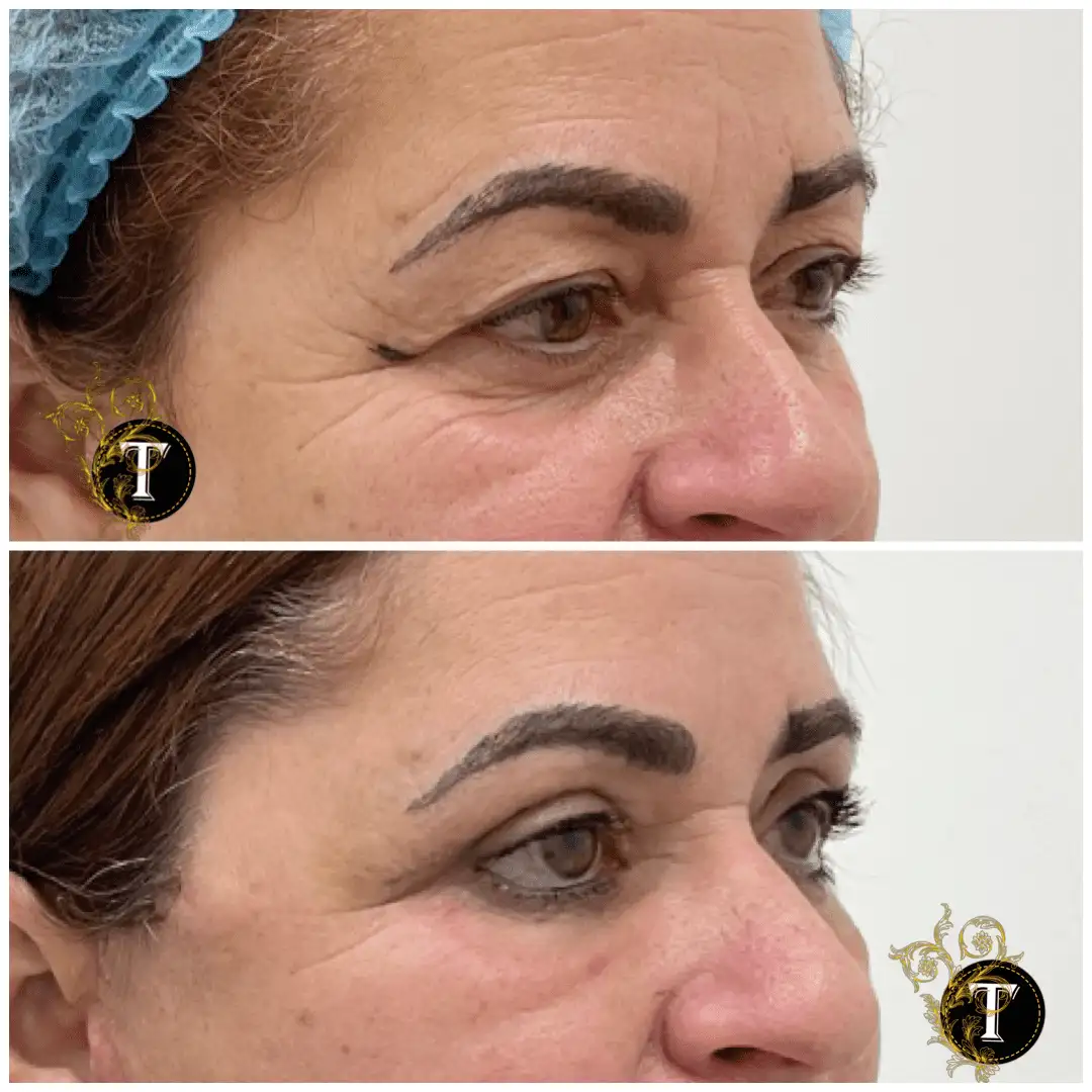 Before and After Image: Eyelid Surgery - right-front-oblique