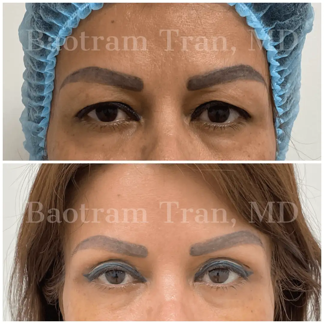 Before and After Image: Eyelid Surgery - front
