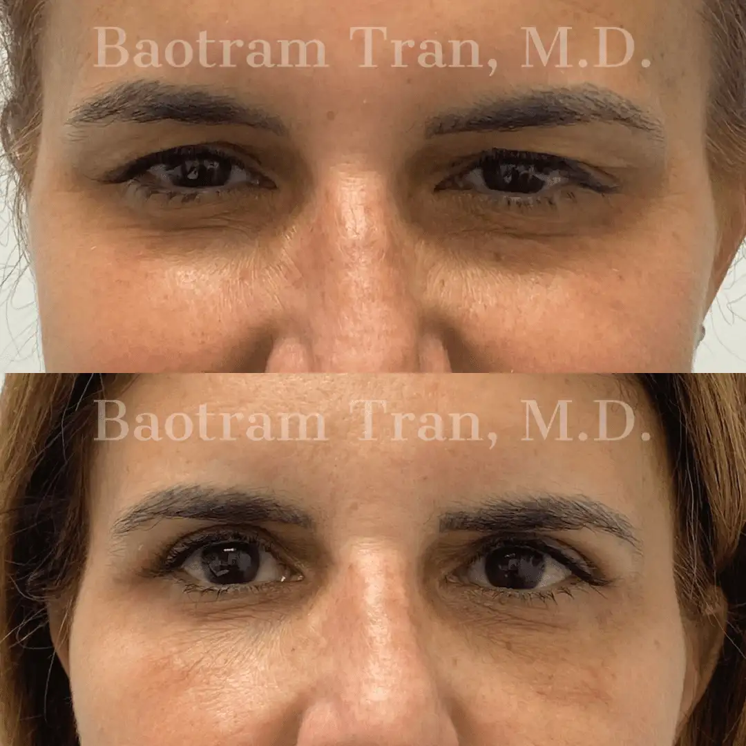 Before and After Image: Eyelid Surgery - front