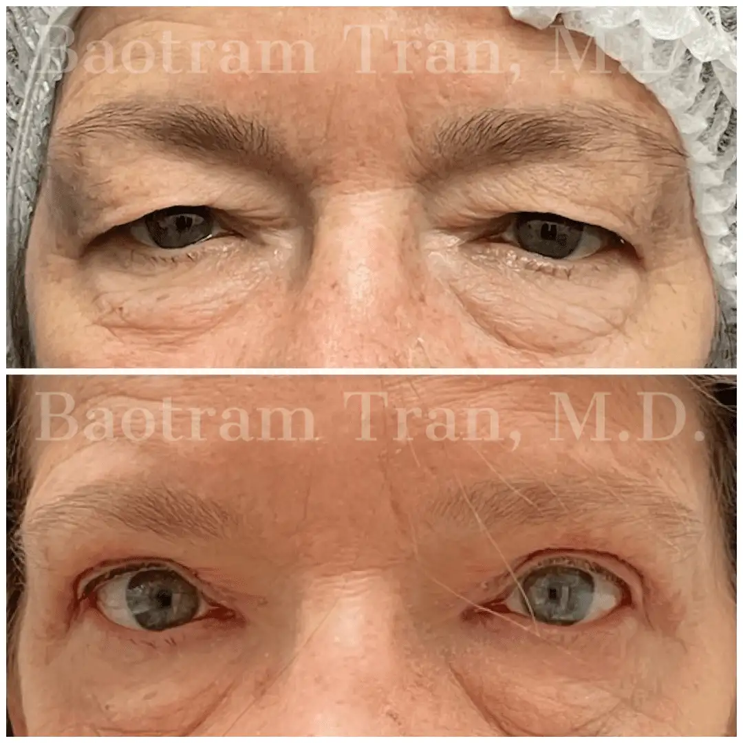 Before and After Image: Eyelid Surgery - front
