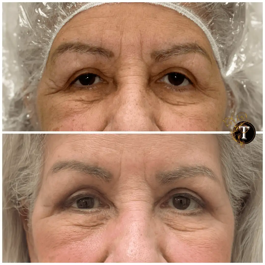 Before and After Image: Eyelid Surgery - front