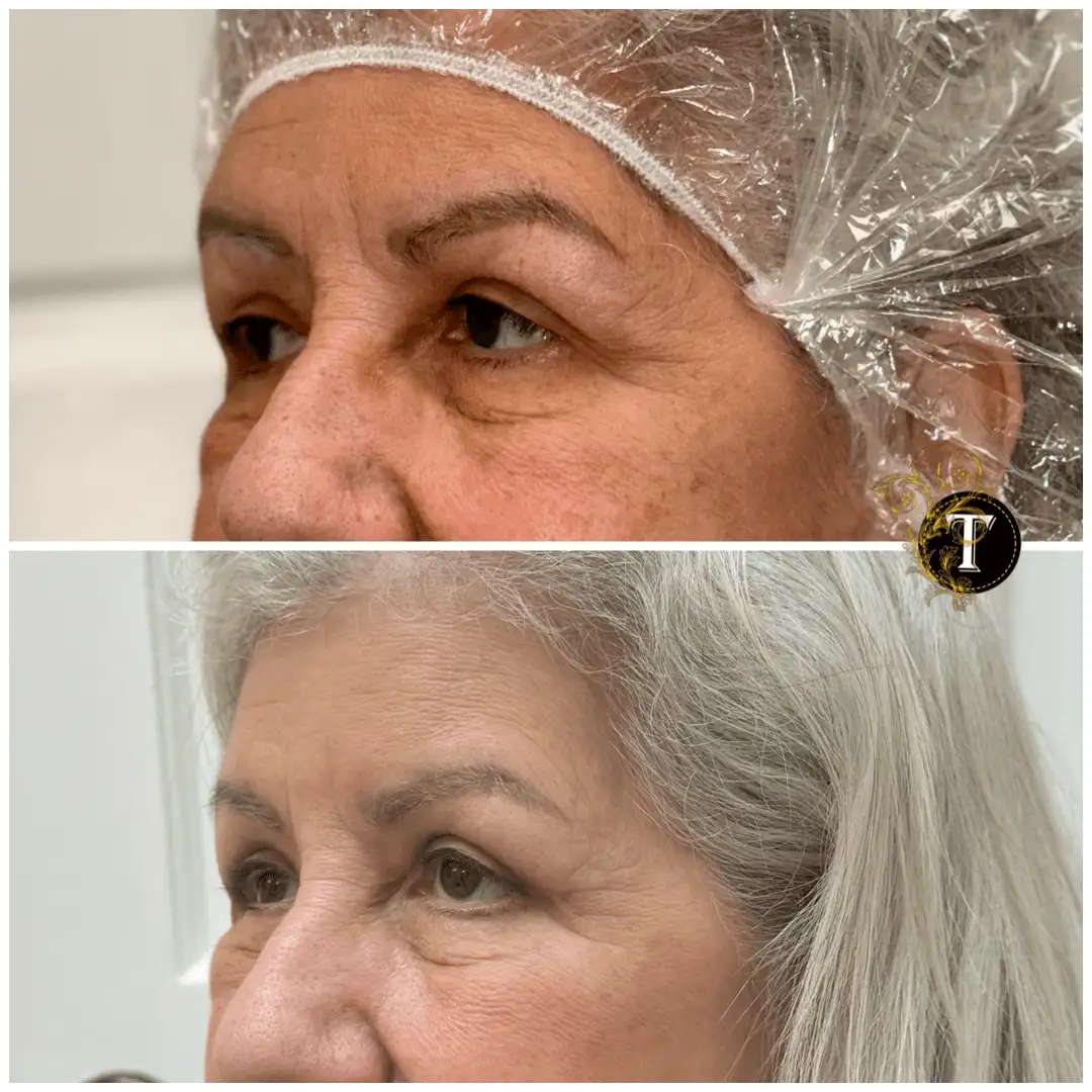 Before and After Image: Eyelid Surgery - left-front-oblique