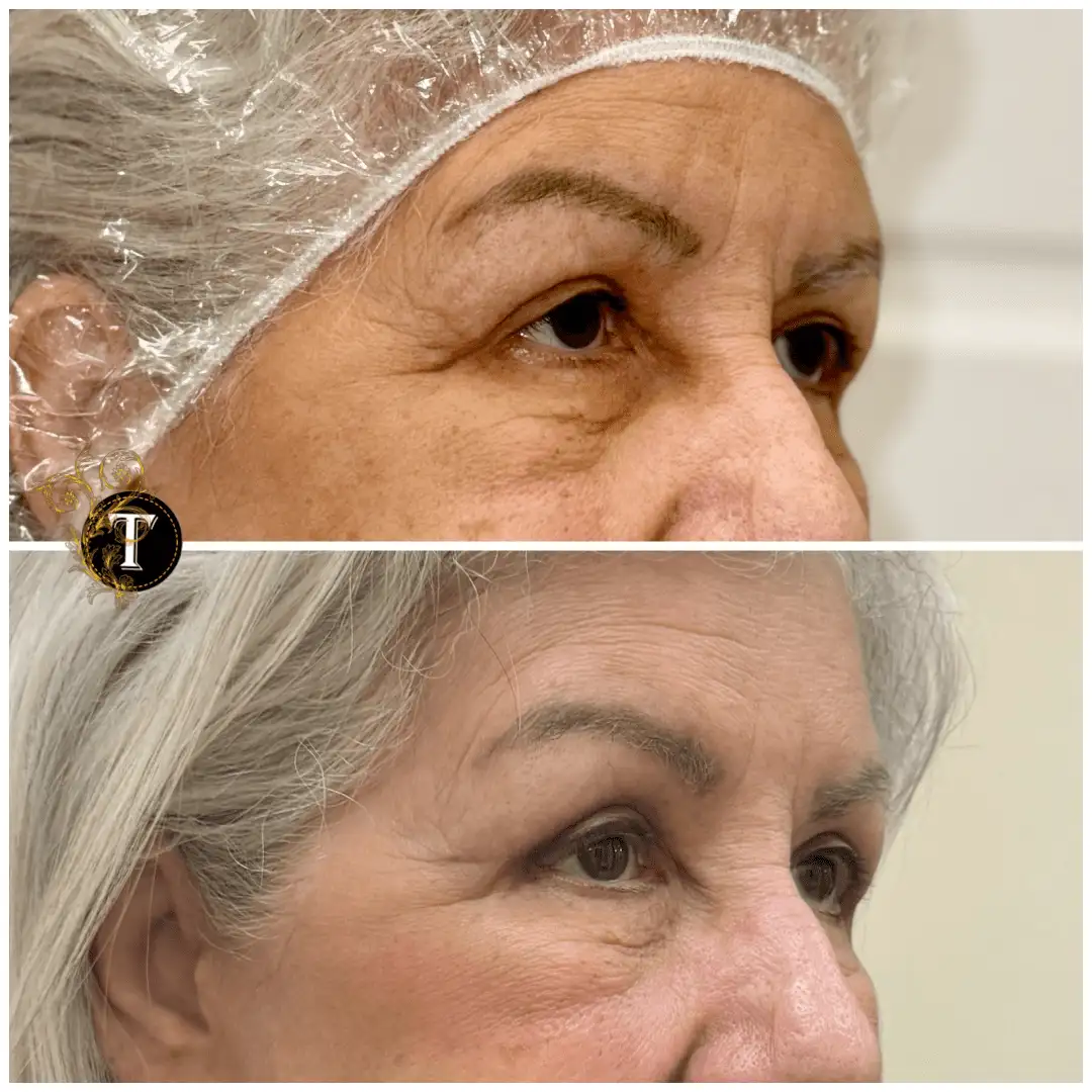 Before and After Image: Eyelid Surgery - right-front-oblique