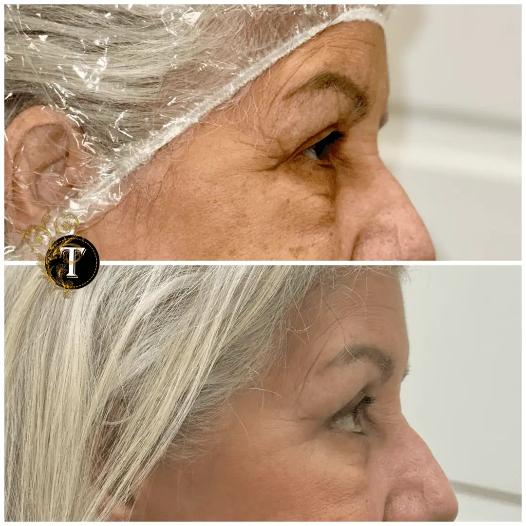 Before and After Image: Eyelid Surgery - right-side