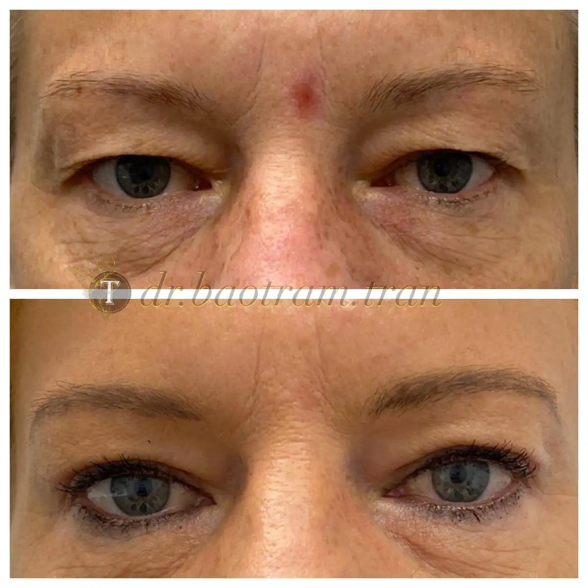 Before and After Image: Eyelid Surgery - front