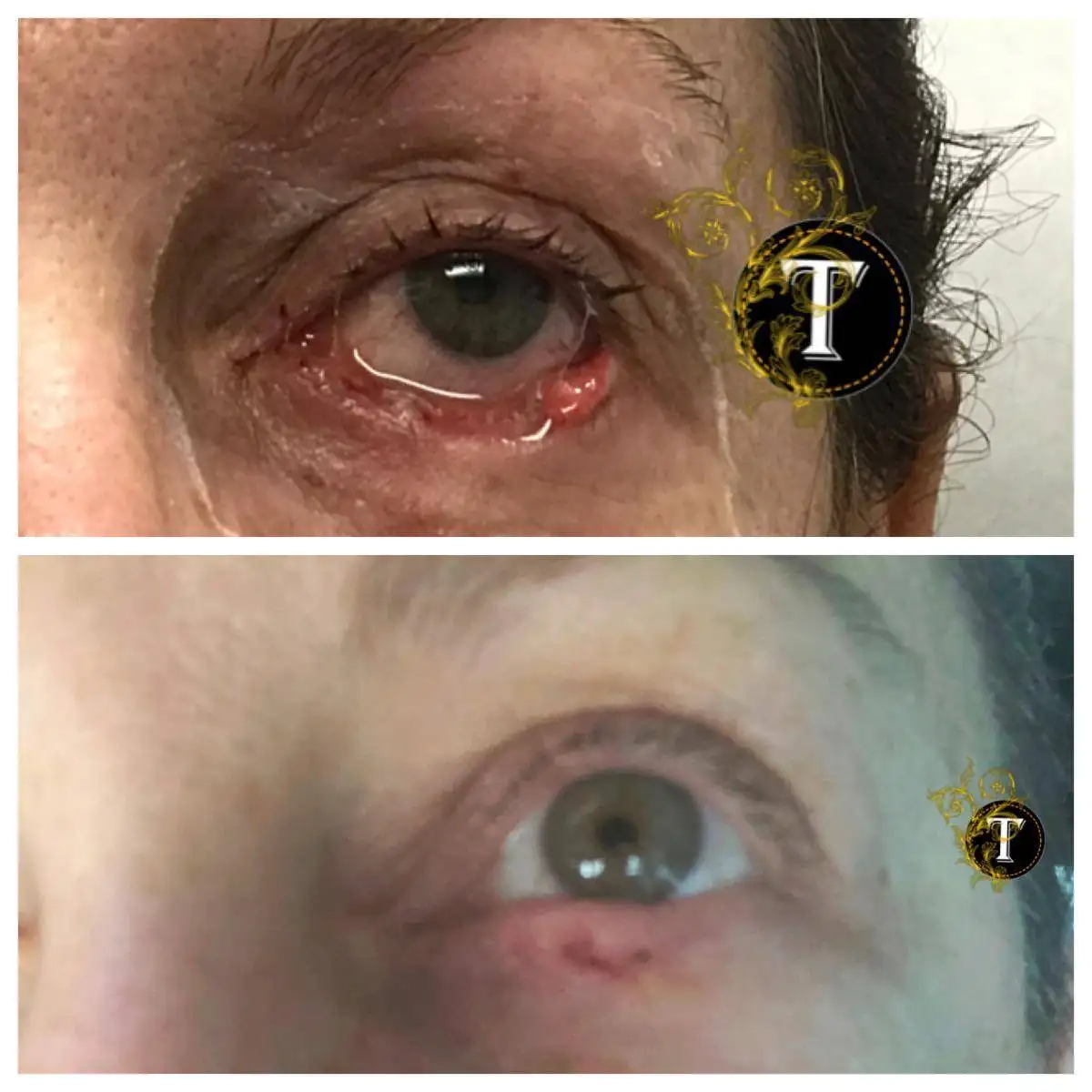 Before and After Image: Eyelid Surgery - front