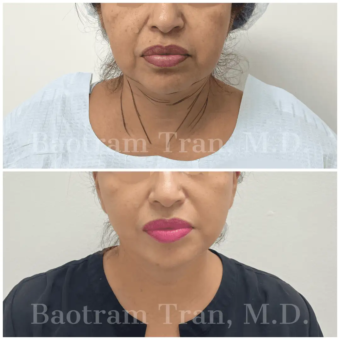 Before and After Image: Facelift & Neck Lift - front