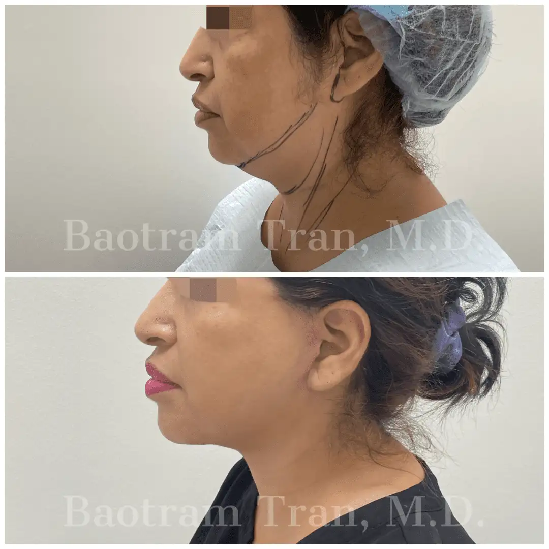 Before and After Image: Facelift & Neck Lift - left-side