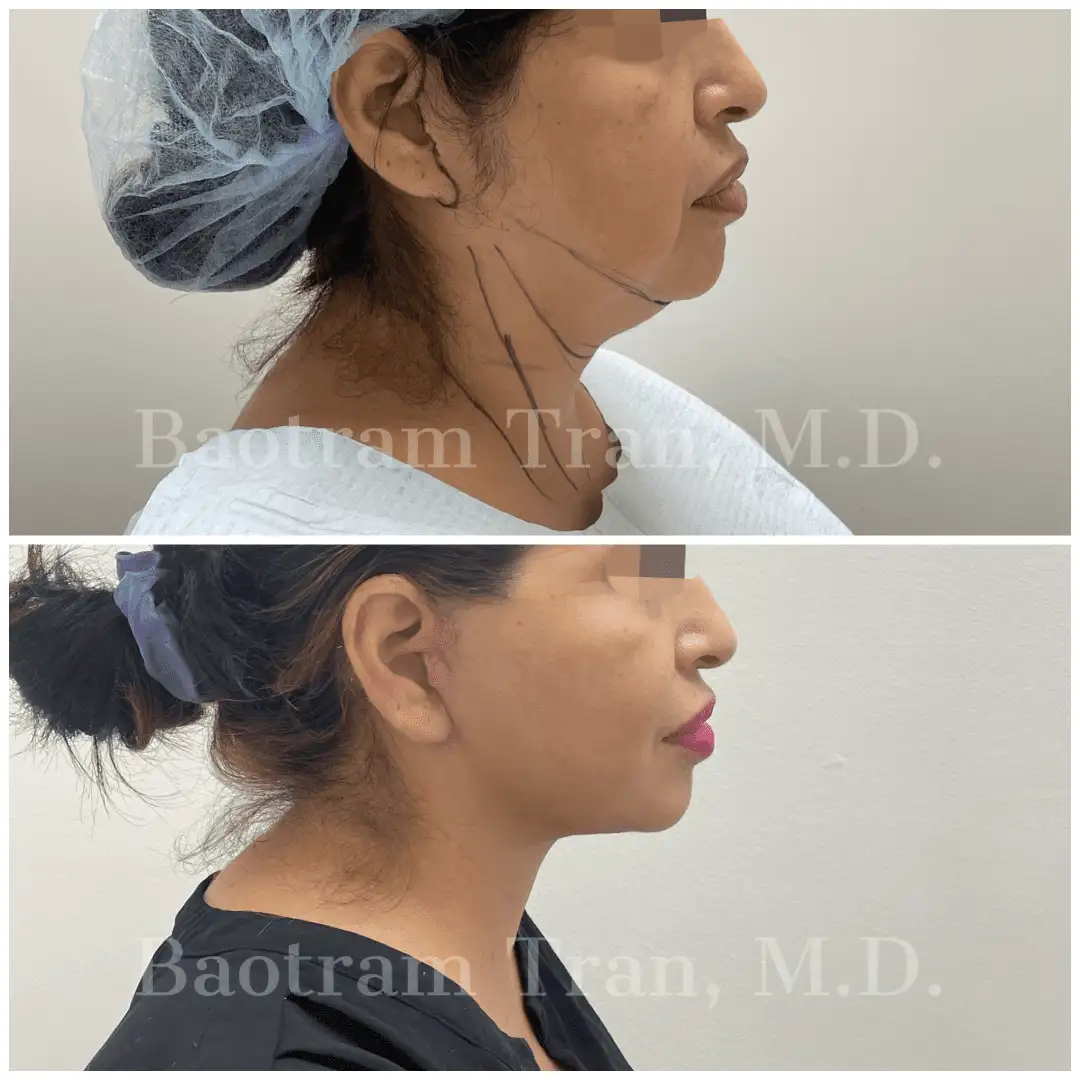 Before and After Image: Facelift & Neck Lift - right-side