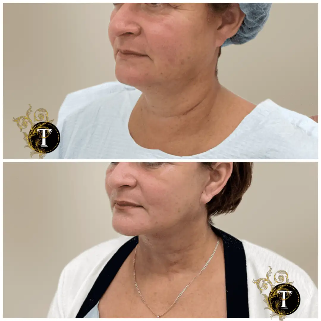 Before and After Image: Facelift & Neck Lift - left-front-oblique