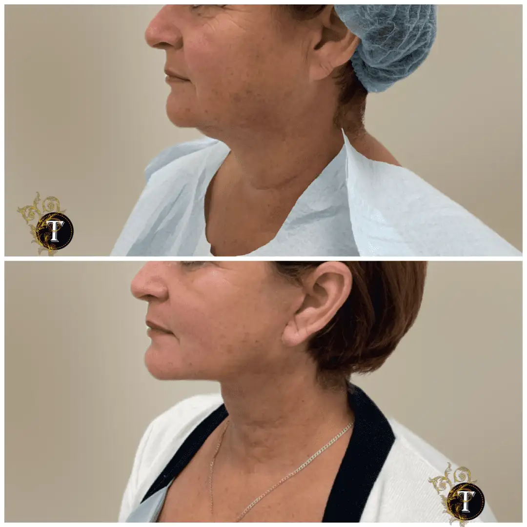 Before and After Image: Facelift & Neck Lift - left-side