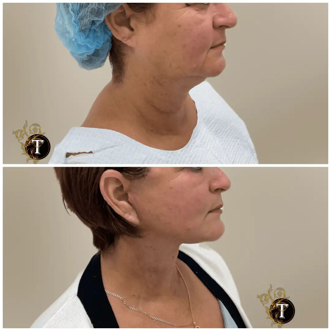 Before and After Image: Facelift & Neck Lift - right-side