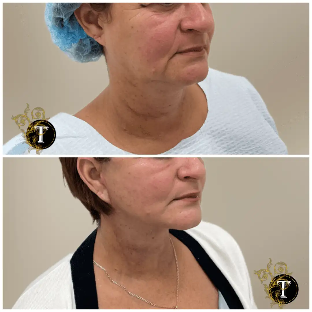 Before and After Image: Facelift & Neck Lift - right-front-oblique