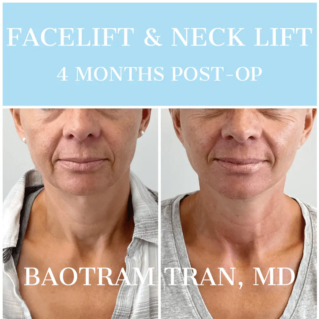 Before and After Image: Facelift & Neck Lift - front