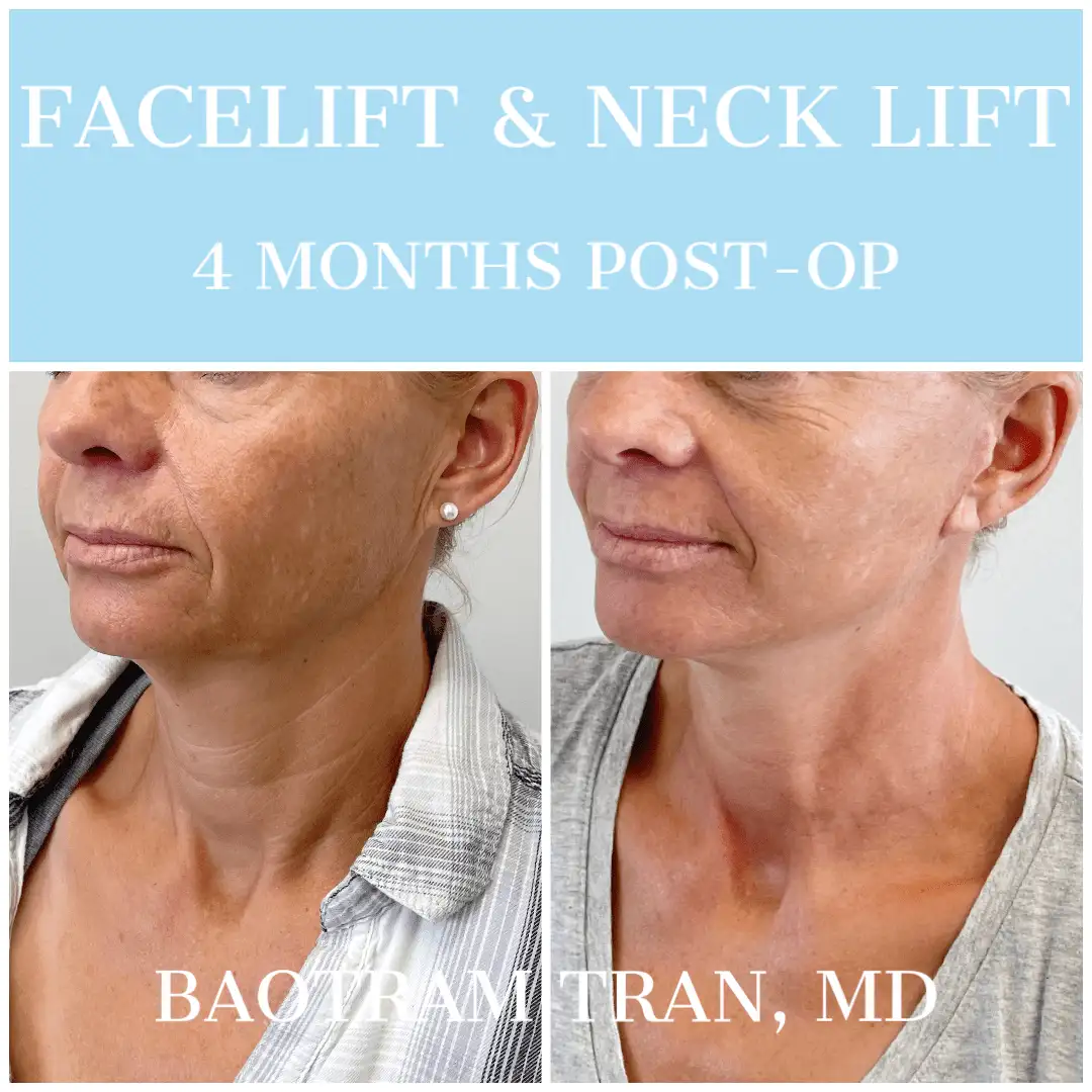 Before and After Image: Facelift & Neck Lift - left-front-oblique