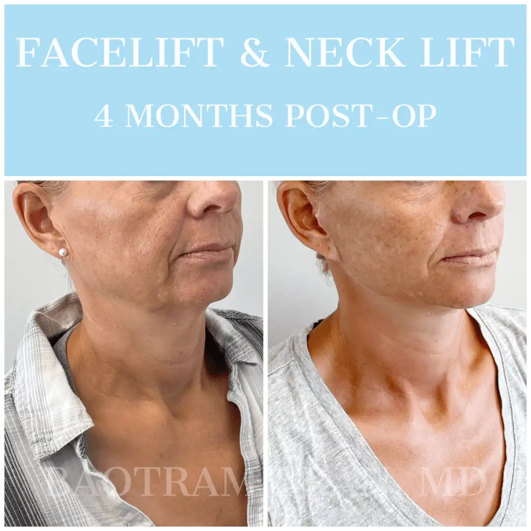 Before and After Image: Facelift & Neck Lift - right-front-oblique