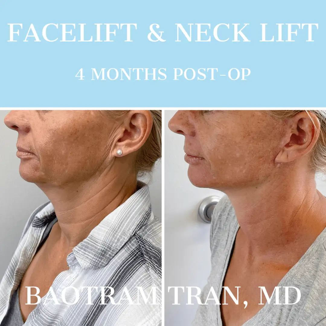 Before and After Image: Facelift & Neck Lift - left-side