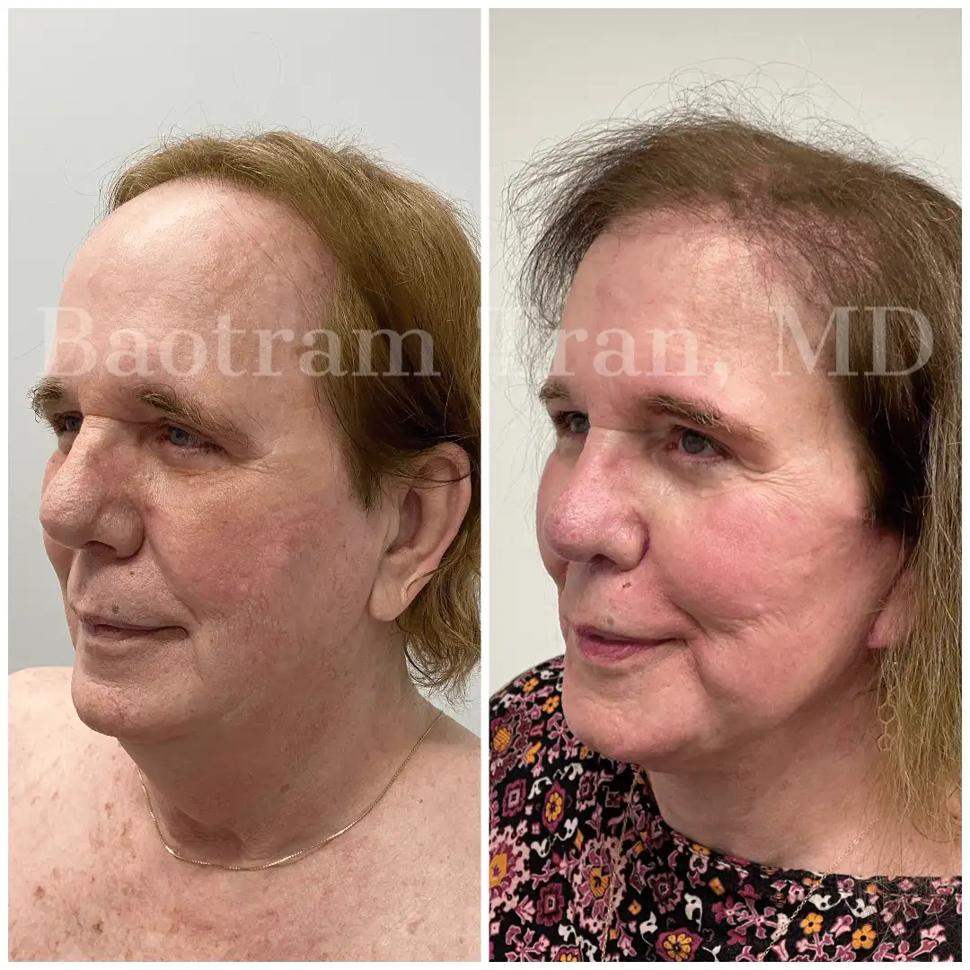 Before and After Image: Facelift & Neck Lift - left-front-oblique