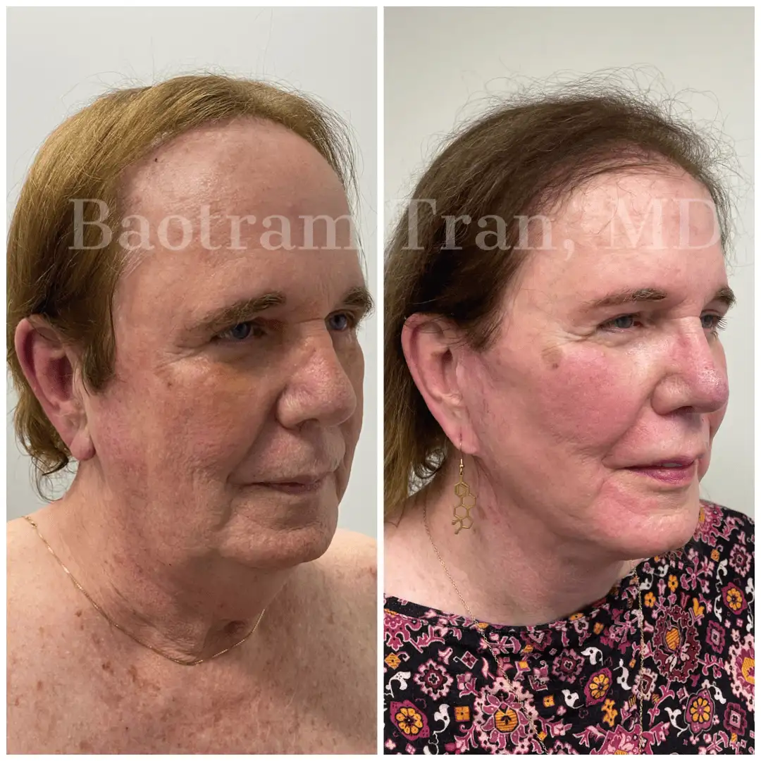 Before and After Image: Facelift & Neck Lift - right-front-oblique