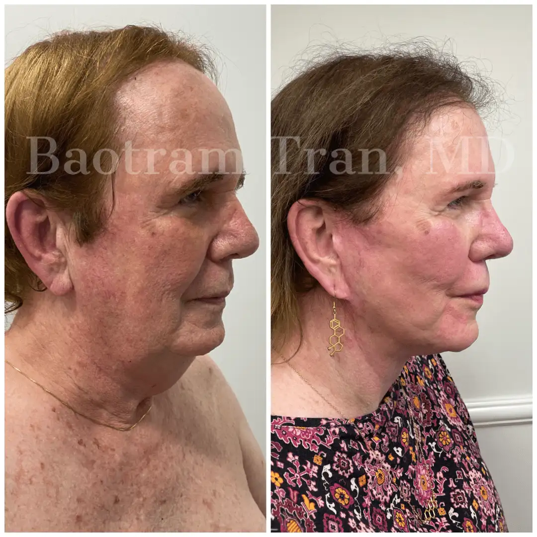 Before and After Image: Facelift & Neck Lift - right-side