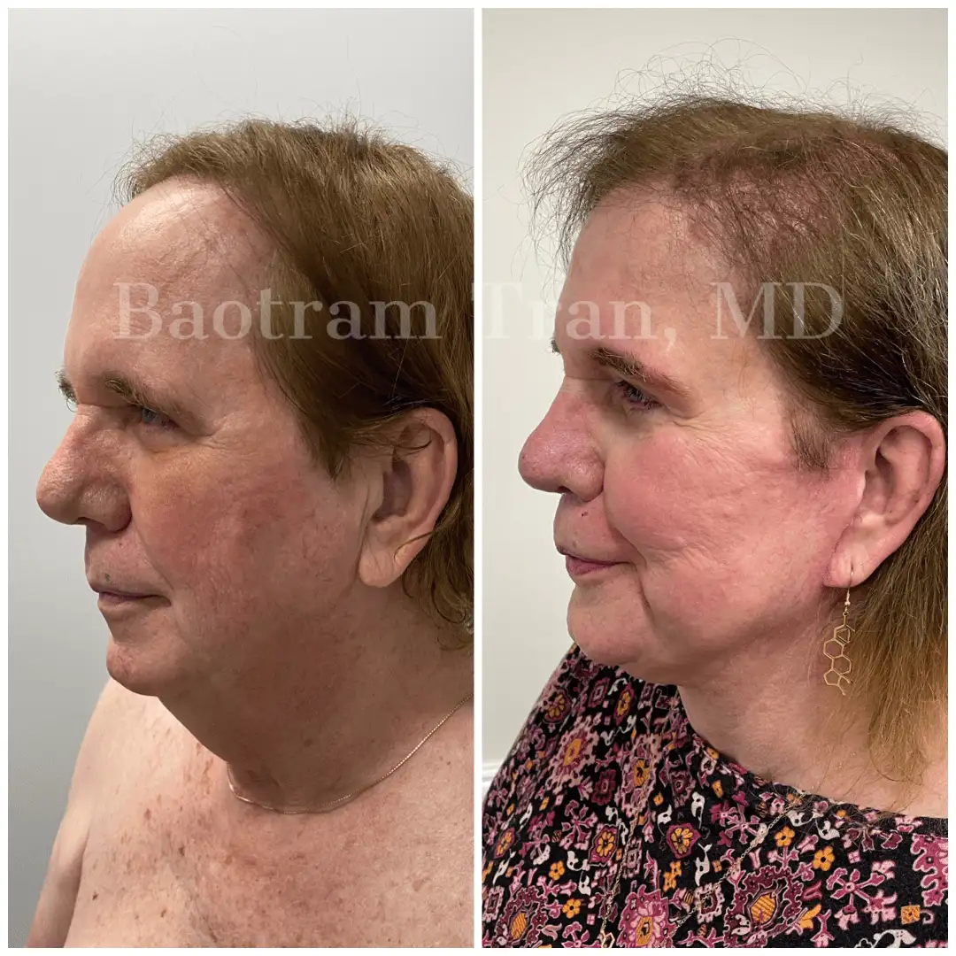 Before and After Image: Facelift & Neck Lift - left-side
