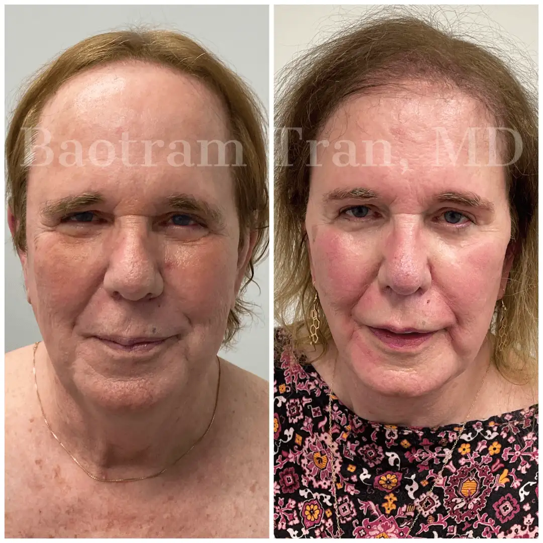 Before and After Image: Facelift & Neck Lift - front