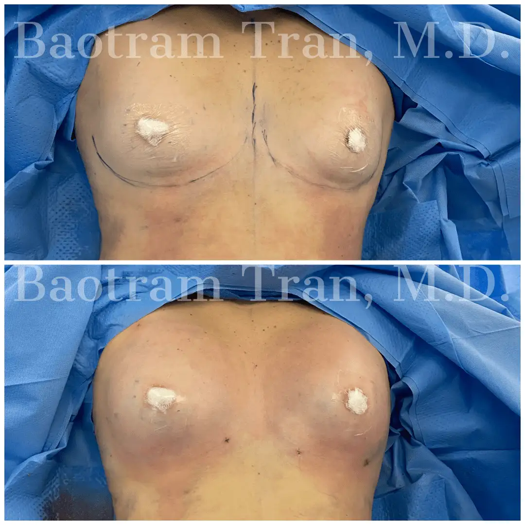 Before and After Image: Fat Transfer - front
