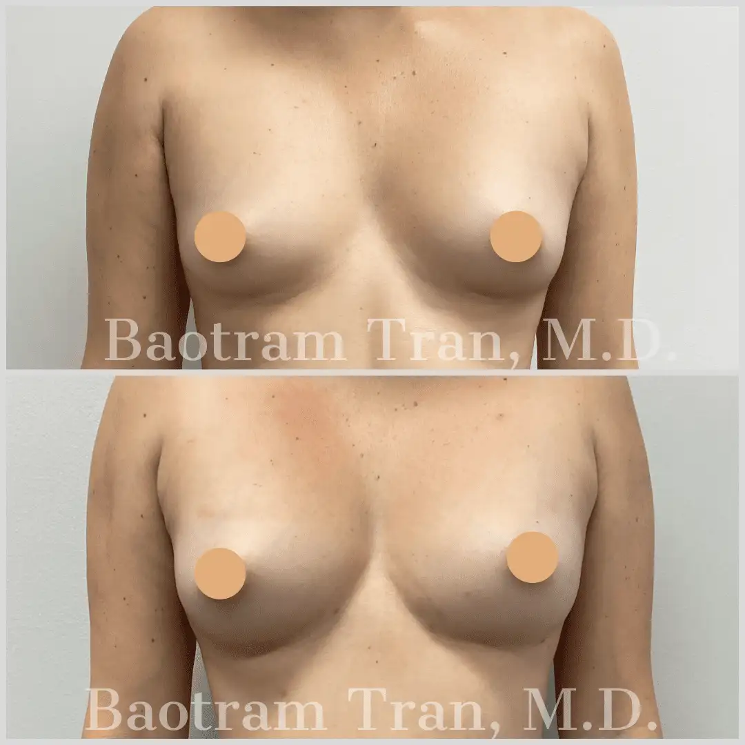 Before and After Image: Fat Transfer - front