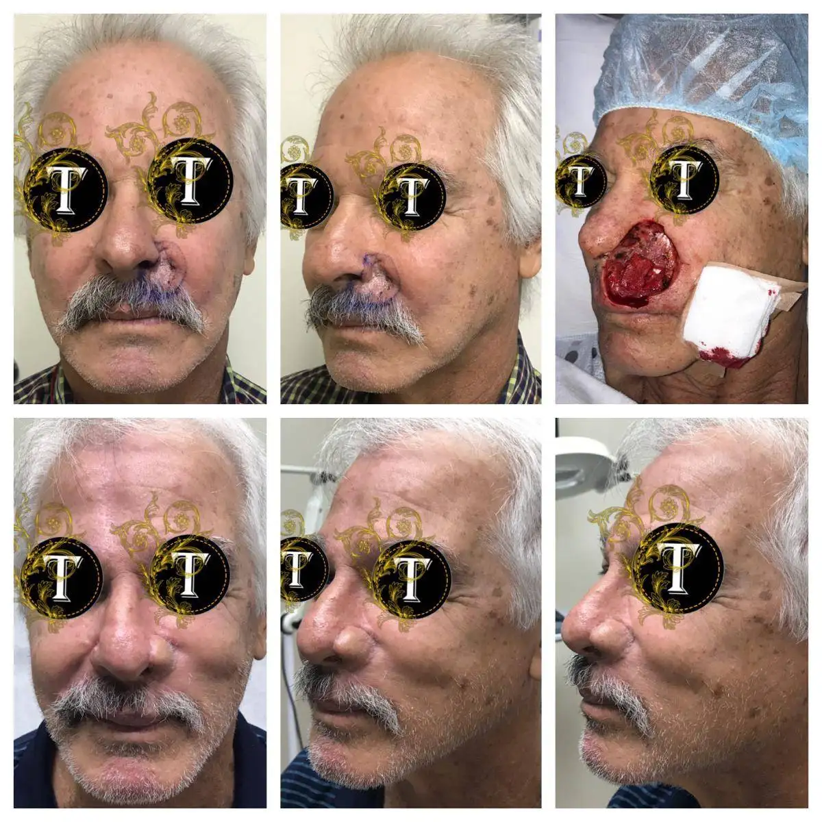 Before and After Image: Facial Reconstruction - front