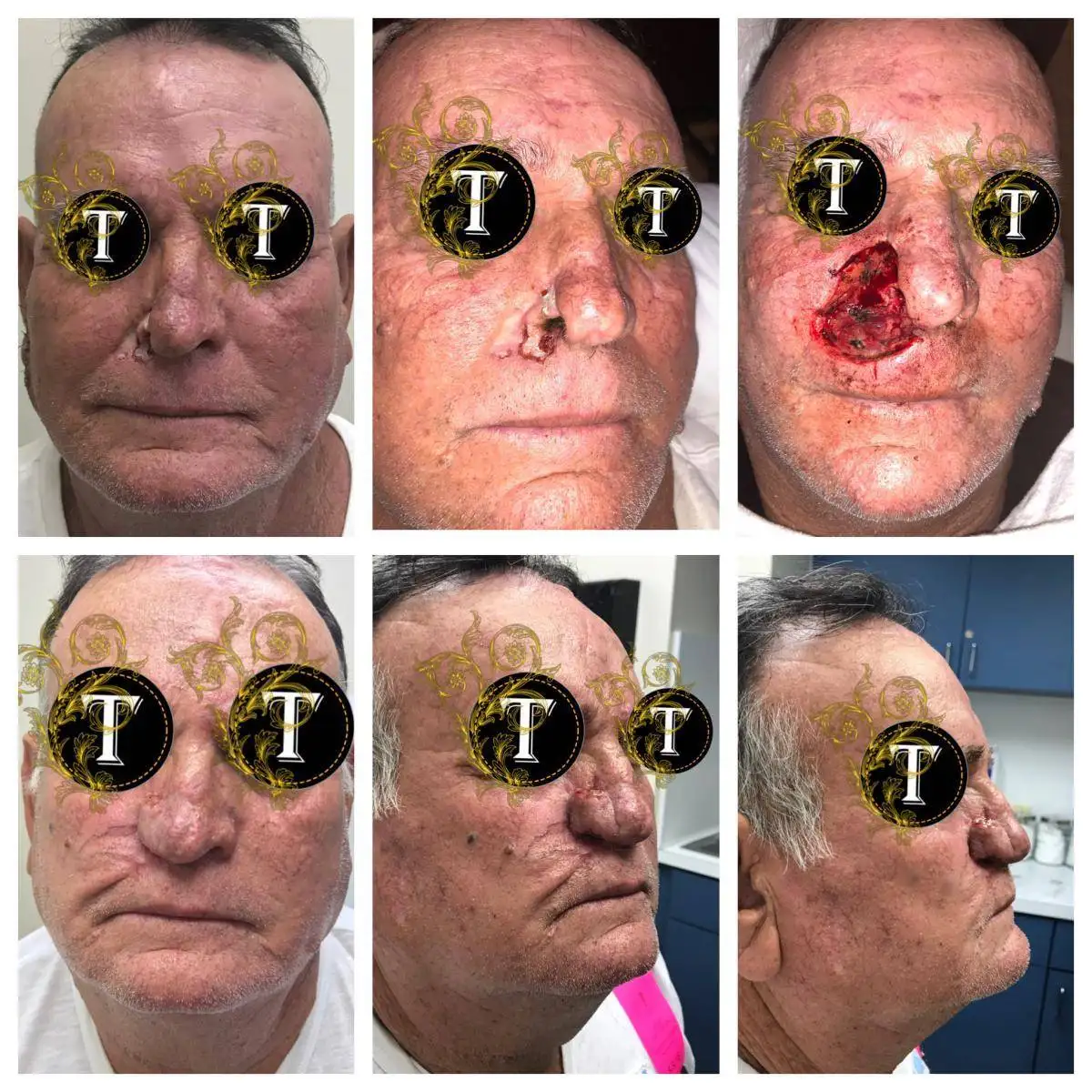 Before and After Image: Facial Reconstruction - front