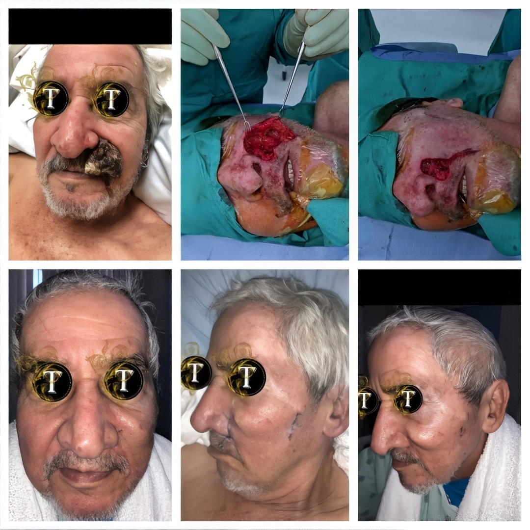 Before and After Image: Facial Reconstruction - front