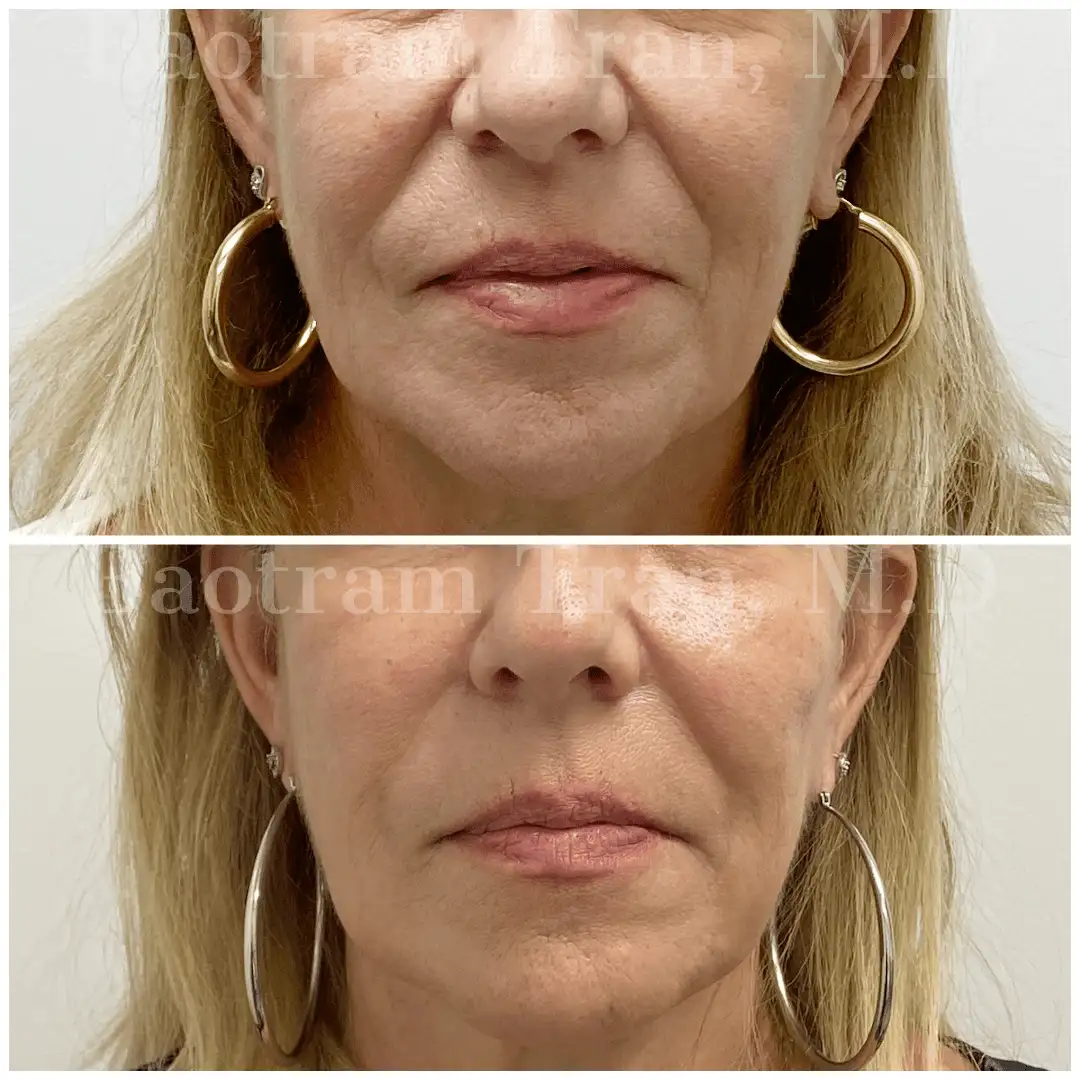 Before and After Image: Facial Thread Lift - front