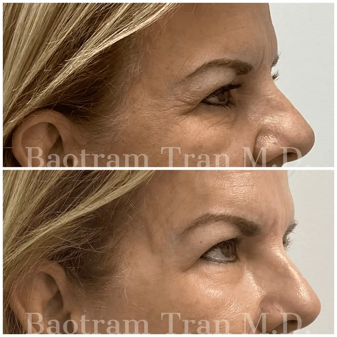 Before and After Image: Facial Thread Lift - right-side