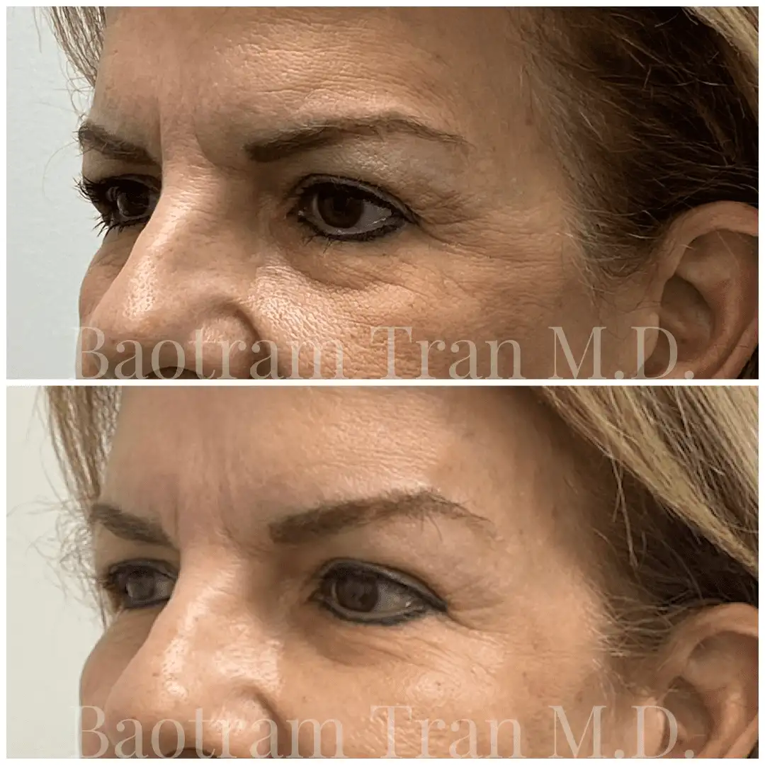 Before and After Image: Facial Thread Lift - left-front-oblique