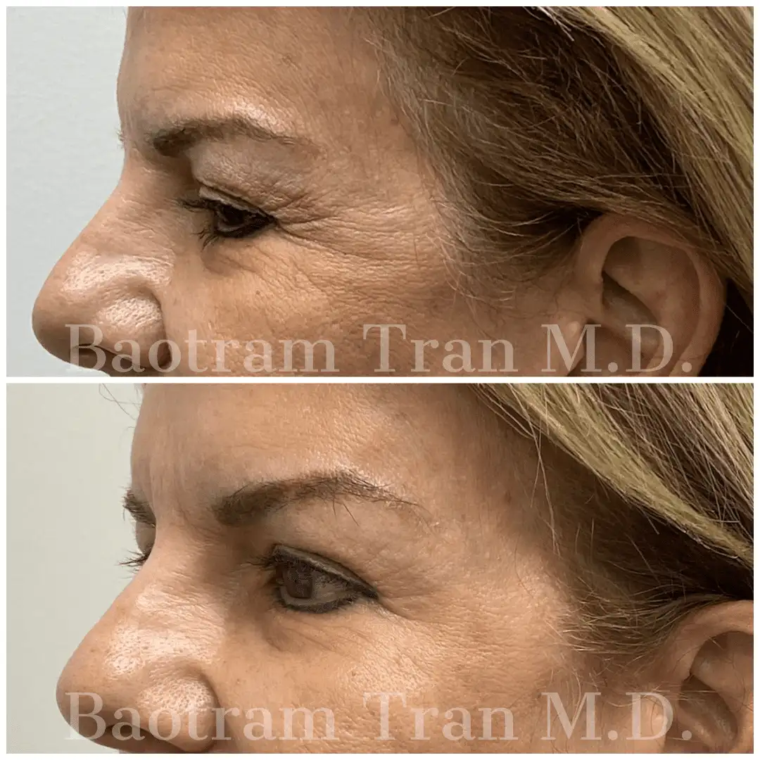 Before and After Image: Facial Thread Lift - left-side