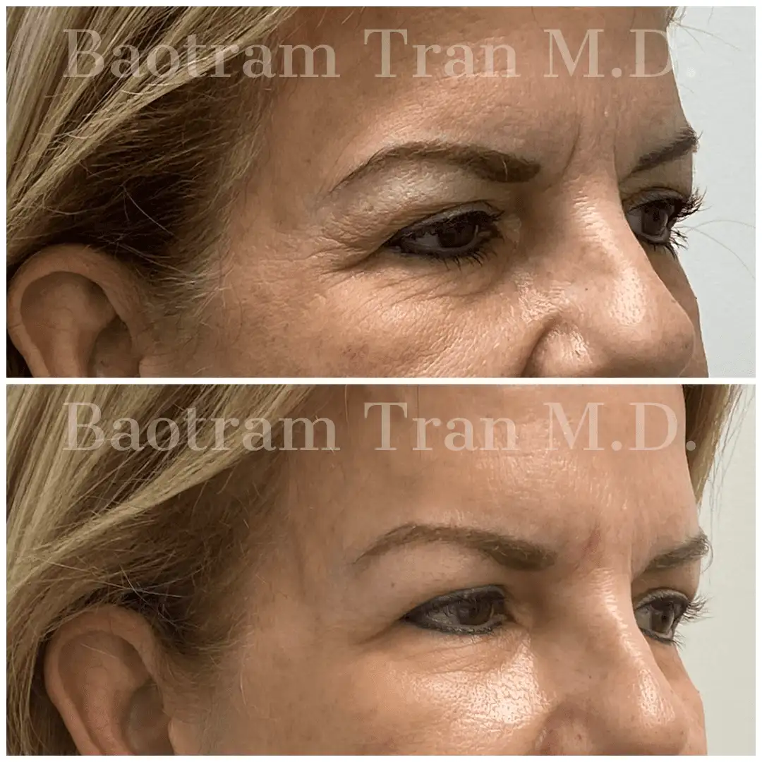 Before and After Image: Facial Thread Lift - right-front-oblique