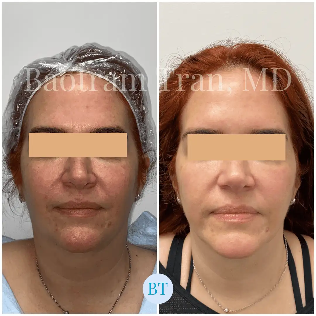 Before and After Image: Facial Thread Lift - front