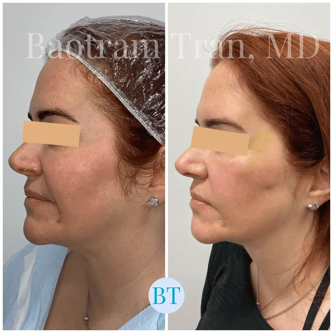 Before and After Image: Facial Thread Lift - left-side