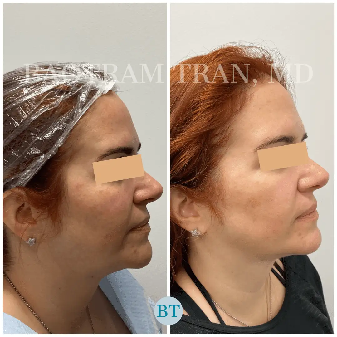 Before and After Image: Facial Thread Lift - right-side