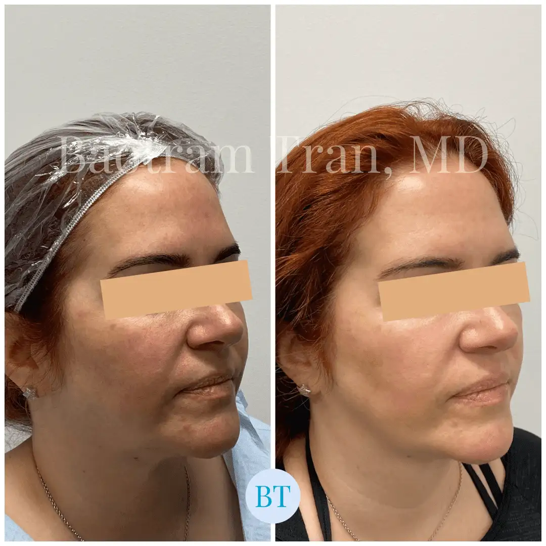 Before and After Image: Facial Thread Lift - right-front-oblique